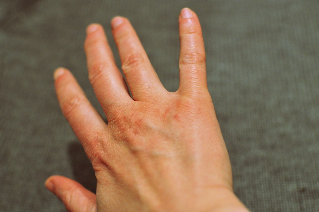 Dry Skin Care: How to Stop the Cracking and Flaking